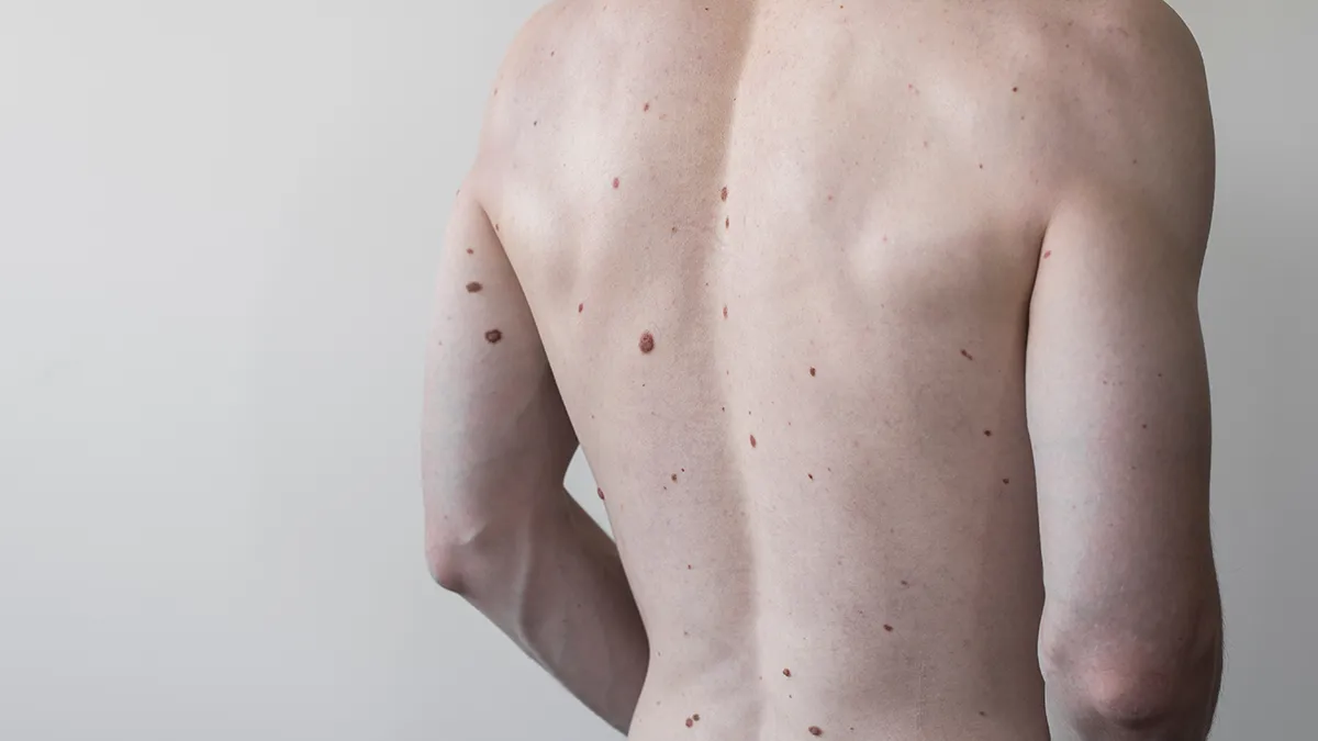 An athletic pale torzo of a man with his entire back full of moles